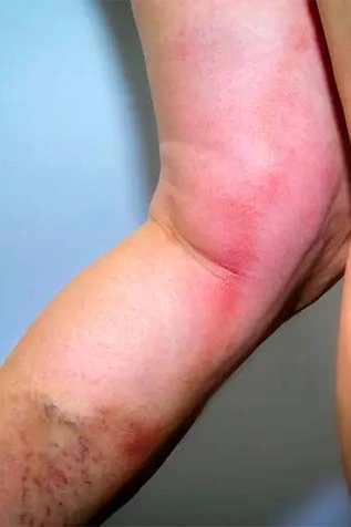 Illustration of Varicose Veins